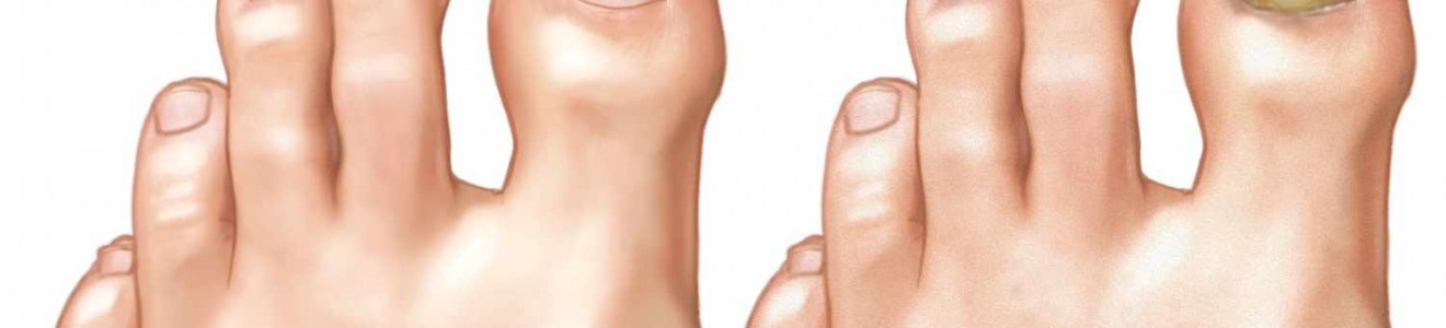 Comparison illustration of healthy normal toenails and toenails infected with fungus showing discoloration and thickening.