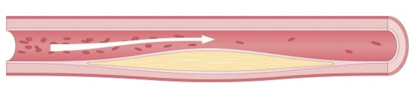 Diagram showing three blood vessels with increasing levels of plaque buildup and restricted blood flow from normal to partially and fully blocked.