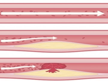 Diagram showing three blood vessels with increasing levels of plaque buildup and restricted blood flow from normal to partially and fully blocked.