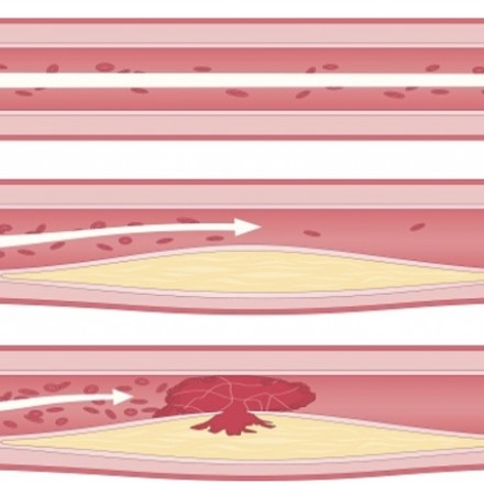 Diagram showing three blood vessels with increasing levels of plaque buildup and restricted blood flow from normal to partially and fully blocked.