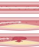 Diagram showing three blood vessels with increasing levels of plaque buildup and restricted blood flow from normal to partially and fully blocked.