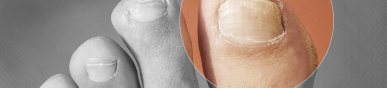 Close-up of a foot with a magnified view highlighting a thickened toenail.