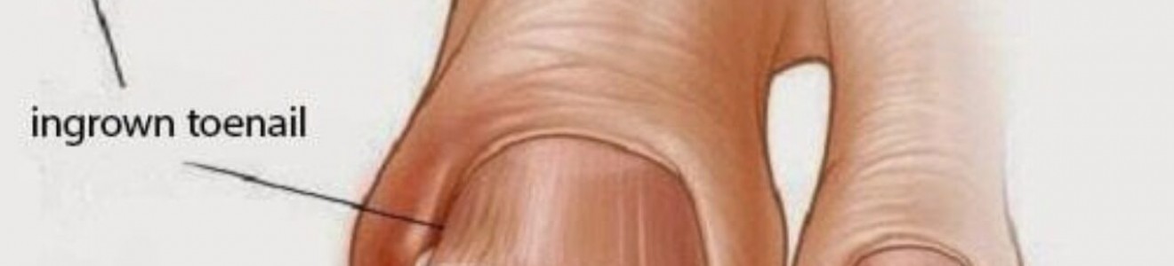 Illustration of a toe with an ingrown toenail and cotton placed under the nail for treatment.