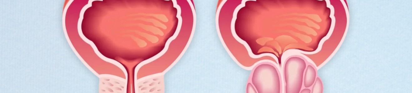 Illustration comparing a healthy prostate gland and an enlarged prostate gland below the bladder.