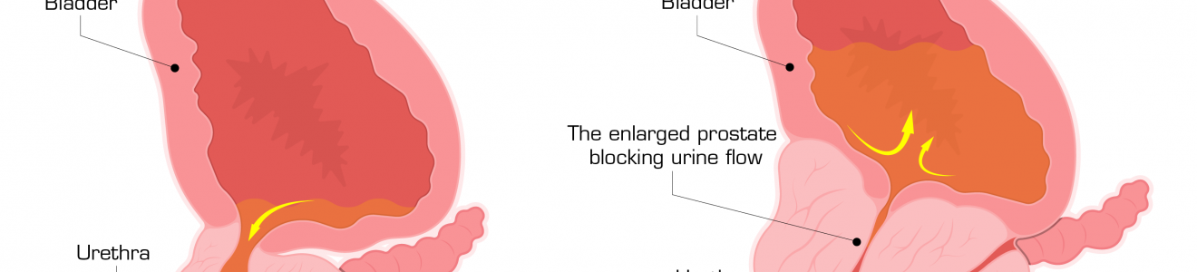 Diagram comparing a normal prostate and an enlarged prostate, showing the bladder, urethra, and urine flow, with the enlarged prostate blocking urine flow.