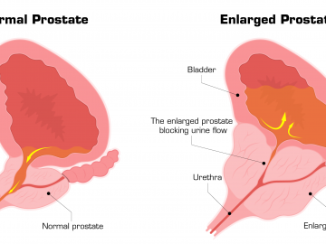 Diagram comparing a normal prostate and an enlarged prostate, showing the bladder, urethra, and urine flow, with the enlarged prostate blocking urine flow.
