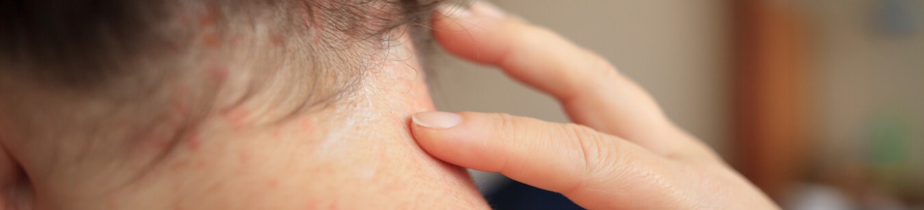 Close-up of a person touching a rash on the back of their neck.