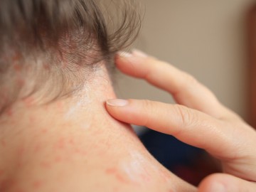 Close-up of a person touching a rash on the back of their neck.