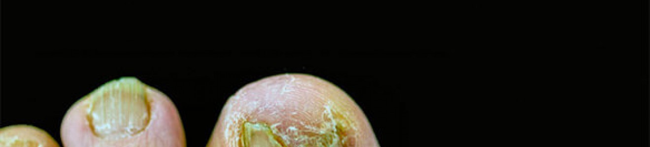 Close-up of toenails with severe fungal infection and discoloration against a black background.