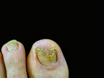 Close-up of toenails with severe fungal infection and discoloration against a black background.