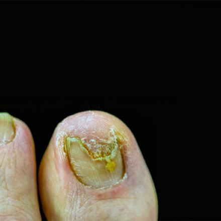 Close-up of toenails with severe fungal infection and discoloration against a black background.