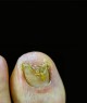 Close-up of toenails with severe fungal infection and discoloration against a black background.