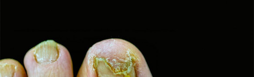 Close-up of toenails with severe fungal infection and discoloration against a black background.
